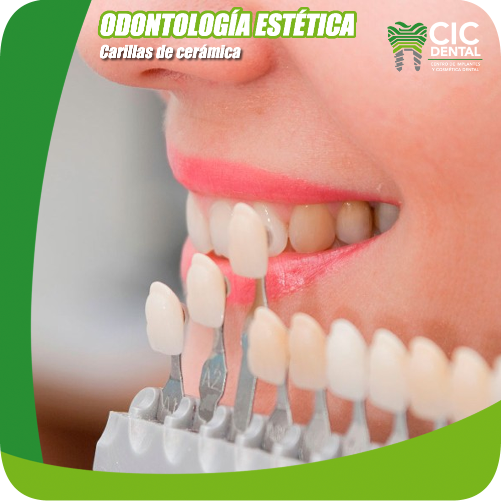 GCD Sitio web Odontología estética Carillas de cerámica