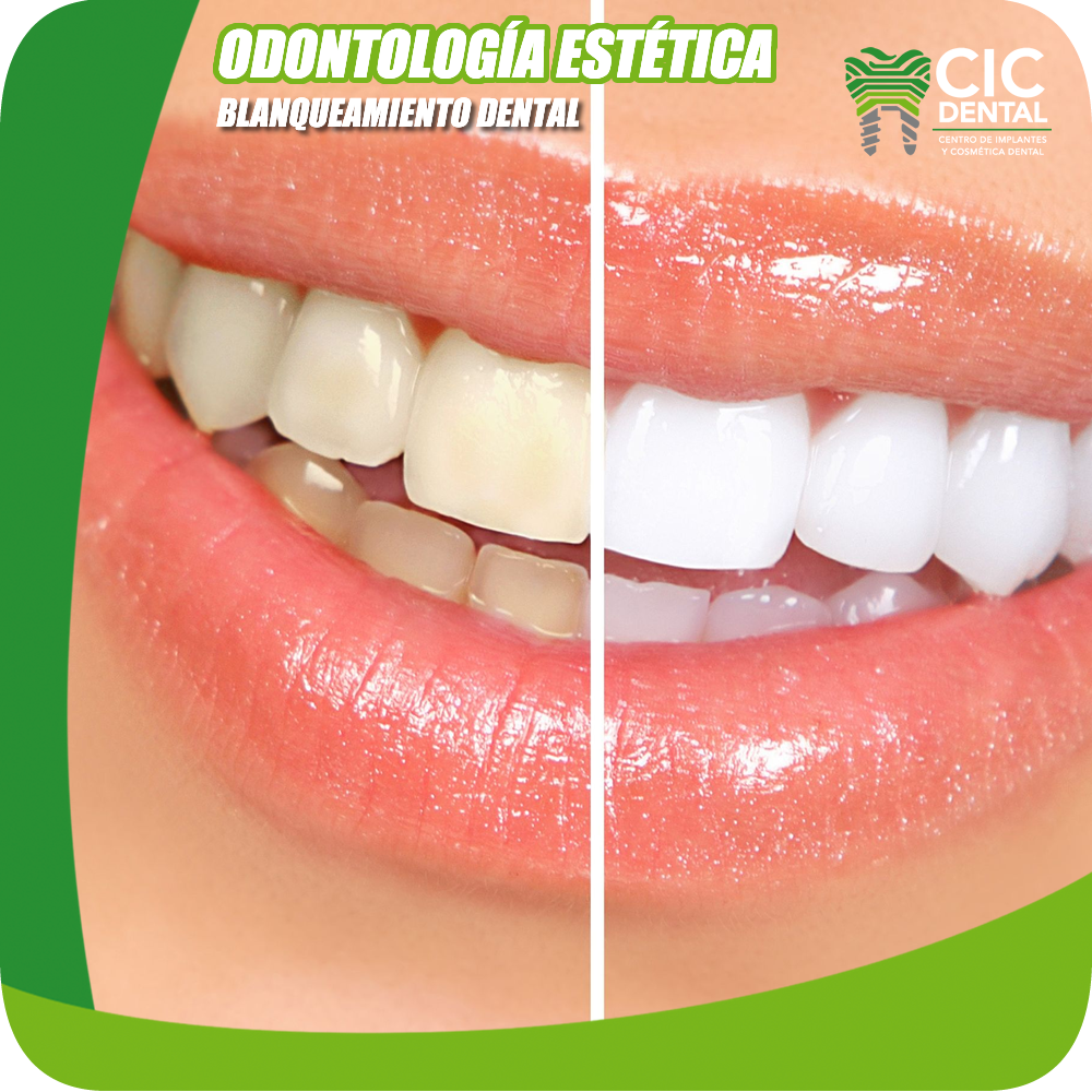 GCD Sitio web Odontología estética blanqueamiento dental