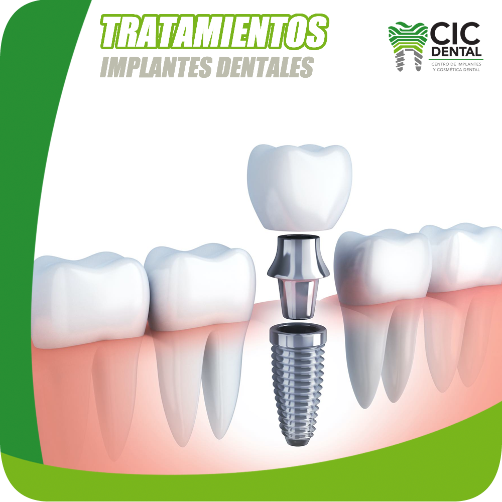 GCD Sitio web tratamientos implantes dentales