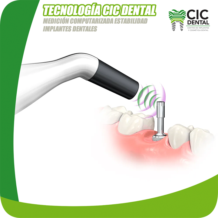 GCD Sitio web Tecnología CD Medición computarizada estabilidad implantes dentales